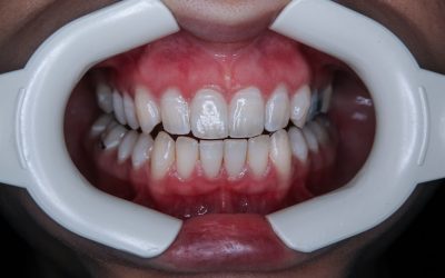 Bleaching: Warum Zahnaufhellung in zahnärztliche Hände gehört