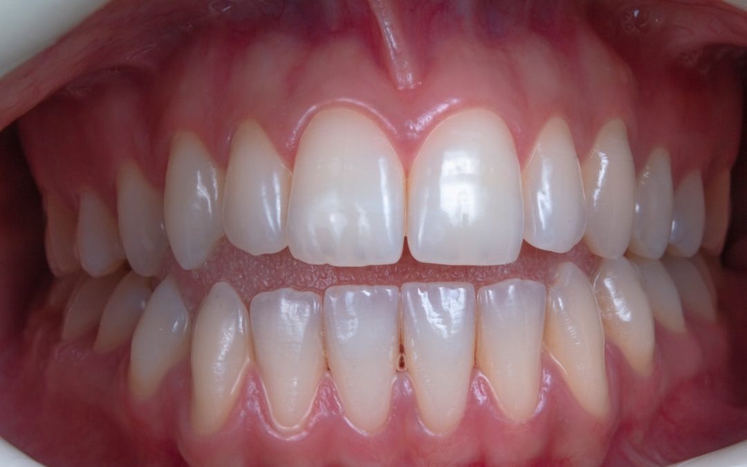 Bleaching: Warum Zahnaufhellung in zahnärztliche Hände gehört